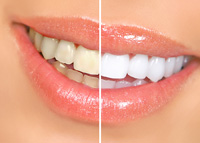 teeth side by side before and after results of professional teeth whitening Warren, OH